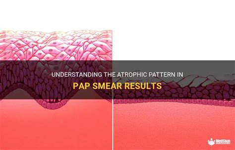 atrophic pattern pap smear|Understanding The Atrophic Pattern In Pap Smear Results.